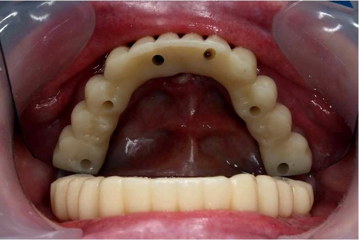 Зубные имплантаты - рекомендации, как выглядит, этапы лечения