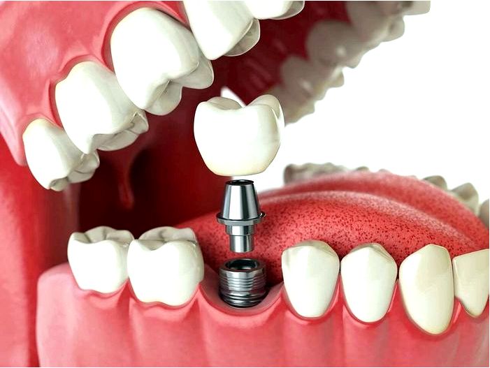 Зубные имплантаты - рекомендации, как выглядит, этапы лечения
