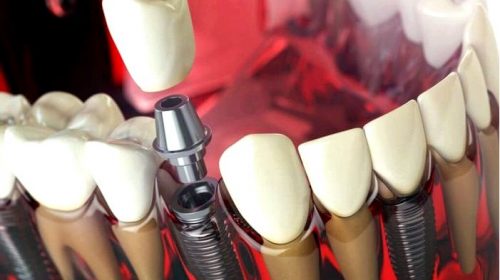 Зубные имплантаты – рекомендации, как выглядит, этапы лечения